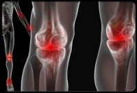 /album/symptomy-lupusu/lupus-4-jpg/