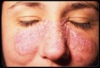 /album/symptomy-lupusu/lupus-5-jpg/